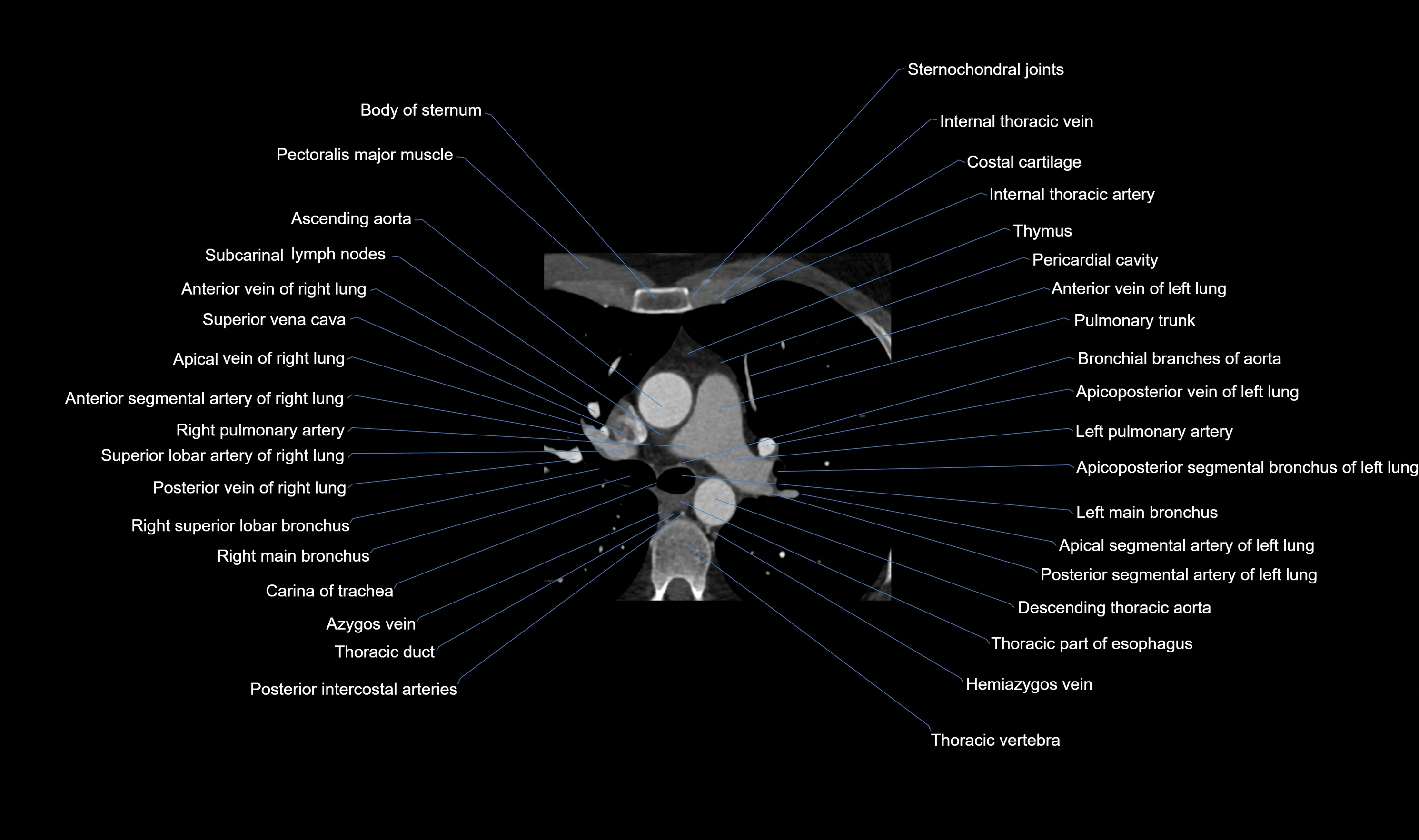 CT heart (coronary angiogram) axial view cross sectional anatomy labelled radiology image-00007.webp